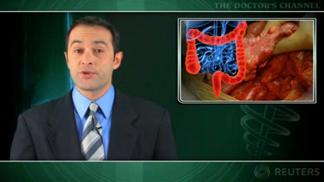 First-line chemo protocol for metastatic colon CA should not include planned discontinuation Thumbnail