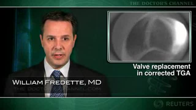 Early valve replacement advocated in corrected transposition of great arteries Thumbnail