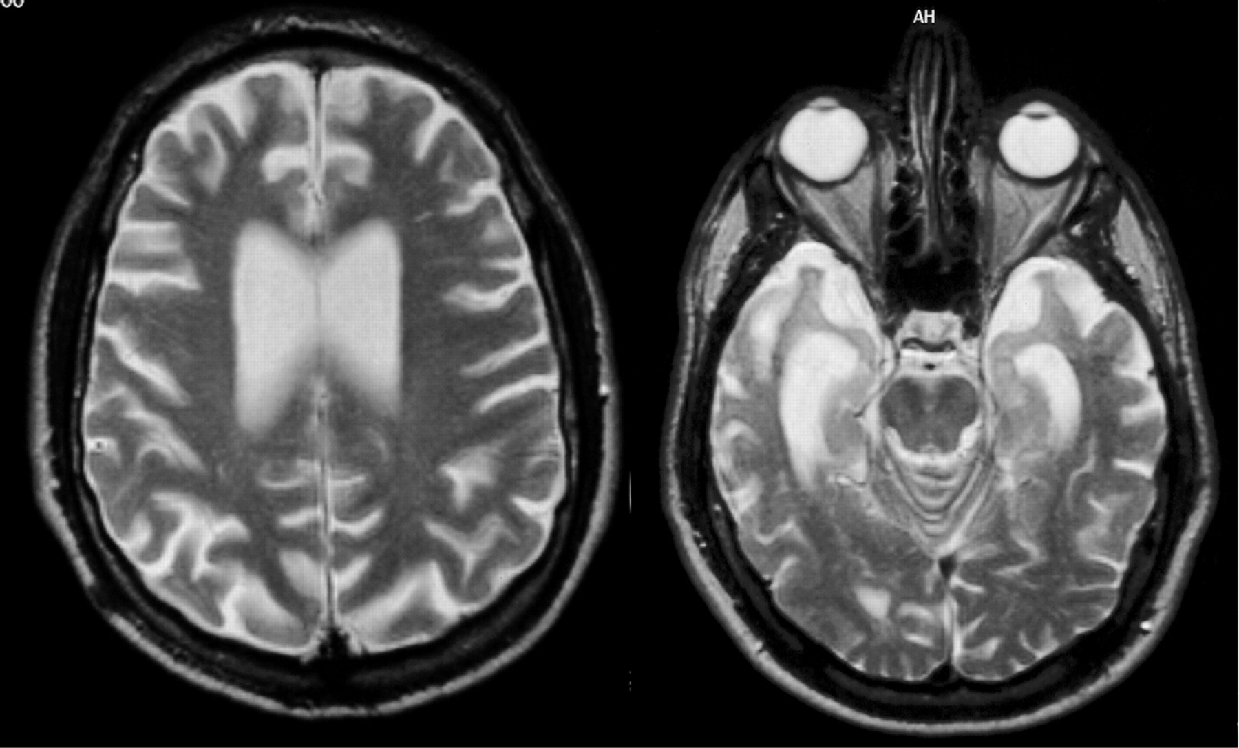 Dementia Brain Mri White Spots