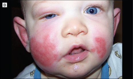 What's Your Diagnosis? Sudden Purpuriform Rash in an Infant - The ...