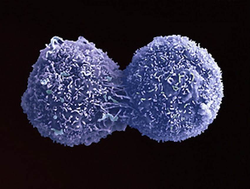 Blood Test Found To Be Efficient Predictor Of Lung Cancer The Doctor 