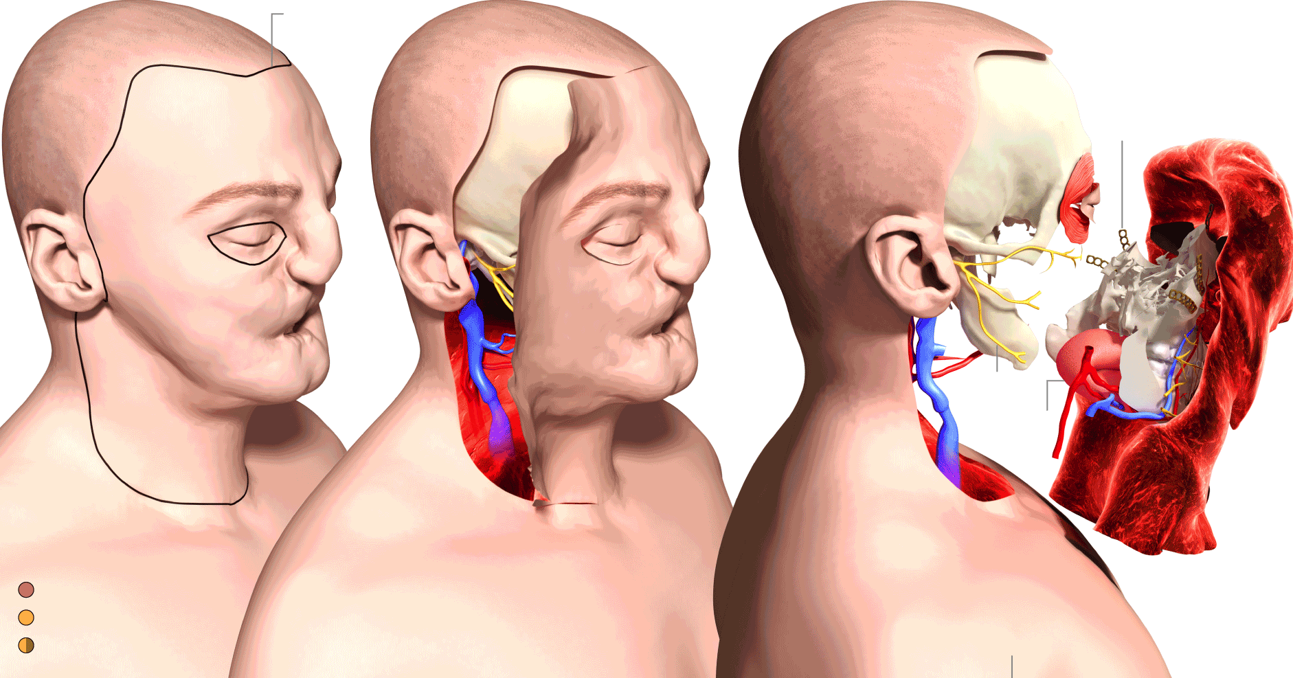 Surprising Findings from the First Ever Review of Face Transplant