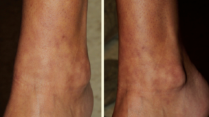 25-Year-Old Female with Asymptomatic Eruption on Both Lower Legs