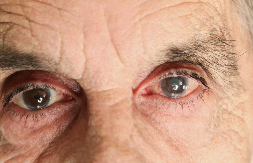 Contact Lens Wearers More Prone to Eye Infections The Doctor's Channel