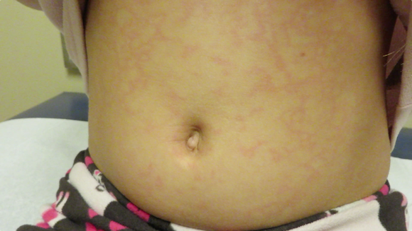 8-Year-Old Girl with Rash Following Viral Illness - The Doctor's Channel