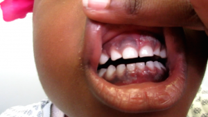 4-Year-Old Girl with Rash on Gums and Leg