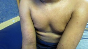 6-Year-Old Boy with Skin Lichenification and Papules