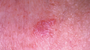 47-Year-Old Male with Asymptomatic Patch on Upper Arm