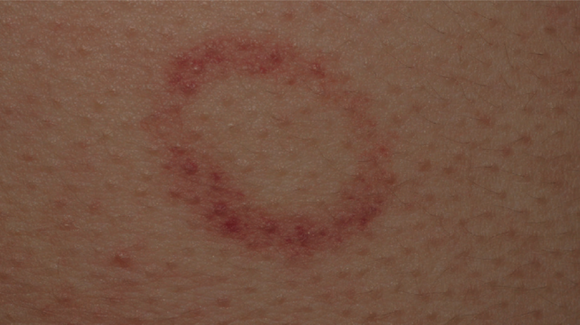 15-Year-Old Male with Annular Rings On Trunk and Thighs - The Doctor's
