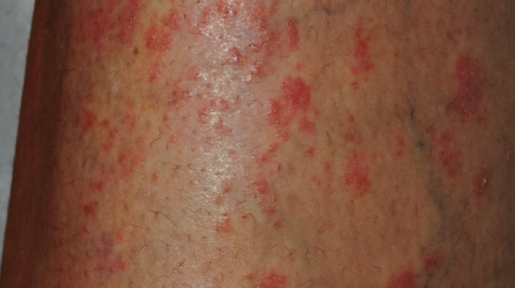 42YearOld Female with Psoriasis and NewOnset Rash The