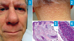 70-Year-Old Male With Papular Eruption and Madarosis