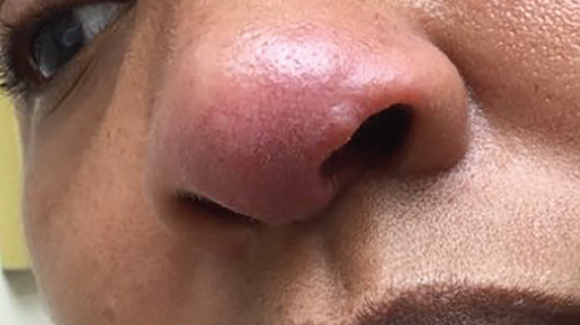 37 Year Old Female With Rash On Tip Of Nose The Doctor s Channel