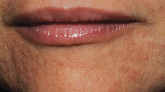 40-year-old-female-with-perioral-rash-around-mouth-the-doctor-s-channel