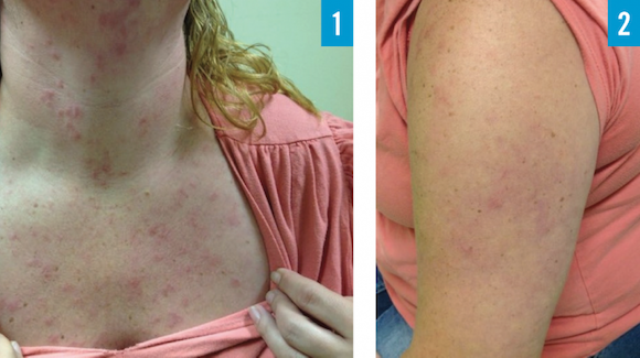 37 Year Old Female With Pruritic Rash On Upper Body The Doctor S