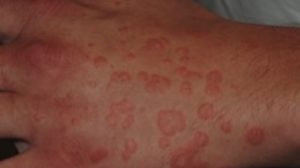 18-Year-Old Male with Widespread Targetoid Rash