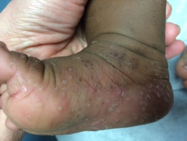 5 Month Old Female With Rash On Feet Soles Hands And Palms The Doctor S Channel