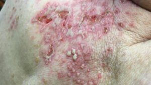 79-Year-Old Male With Erythematous Rash Containing Pustules and Open Sores