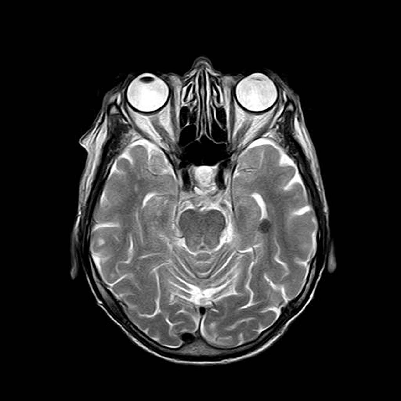 What Actually Causes Chronic Traumatic Encephalopathy? Thumbnail