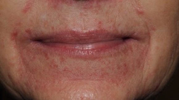 61-year-old-female-with-5-day-history-of-sudden-pruritic-rash-around