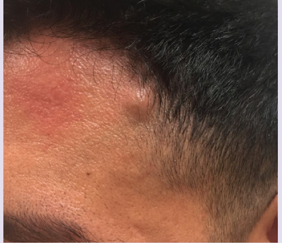 Lump On Left Side Of Head Near Temple