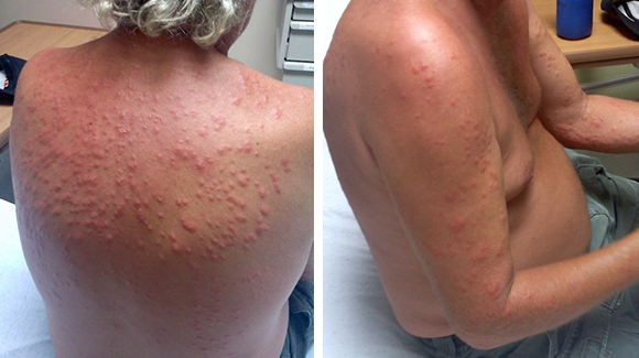 73 Year Old Male With Pruritic Dry Rash Of Upper Extremities The Doctor S Channel 73 Year Old Male With Pruritic Dry Rash Of Upper Extremities The Doctor S Channel