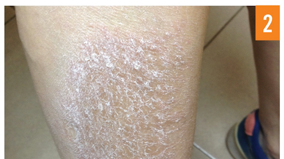 65-year-old-female-with-pruritic-dry-scaly-skin-on-lower-legs-the