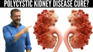 Click to View Polycystic Kidney Disease Breakthrough (New Research in PKD) – 2023