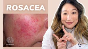 Click to View Dermatologist Guide to Rosacea – Treatments & Skincare Products