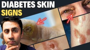 Click to View Doctor Explains 13 Skin Signs of Diabetes – Never Ignore These Symptoms
