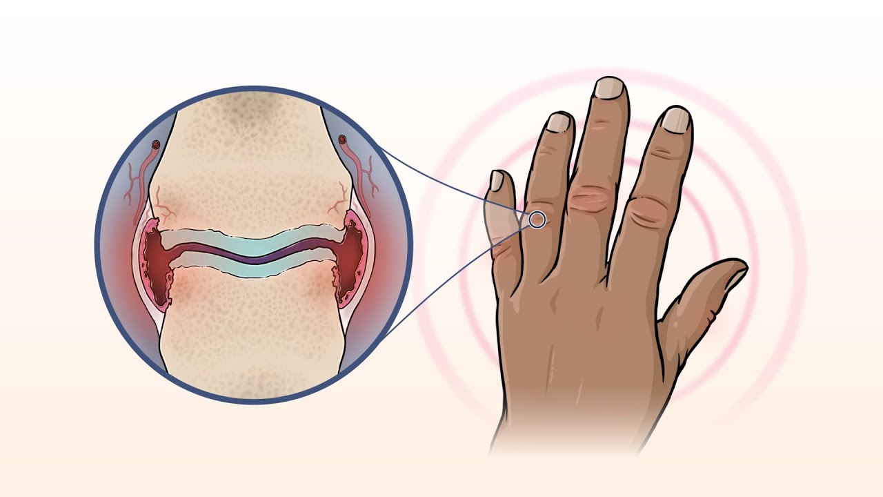 What Is Rheumatoid Arthritis? | NEJM Thumbnail