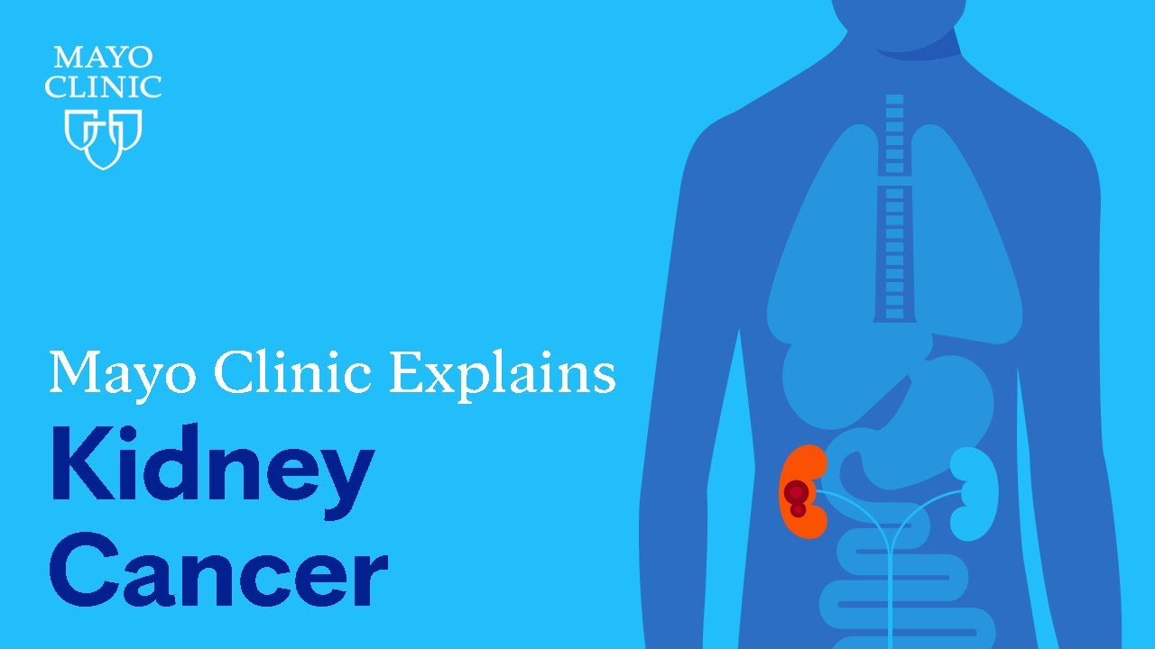 Mayo Clinic Explains Kidney Cancer Thumbnail