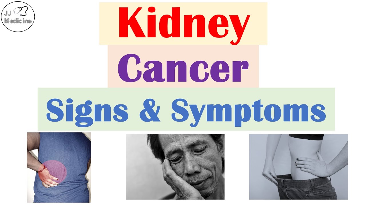 Kidney Cancer (Renal Cell Carcinoma) Signs and Symptoms & Why They Occur Thumbnail