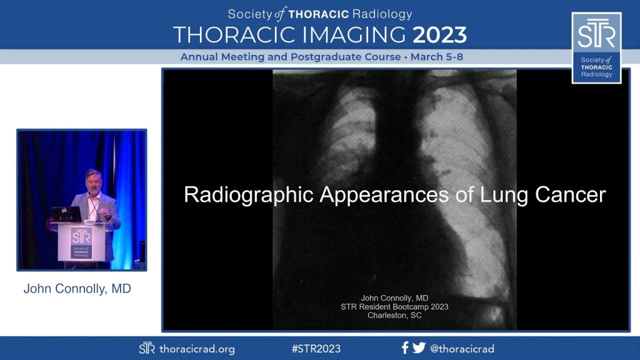 Radiographic Appearances of Lung Cancer Thumbnail