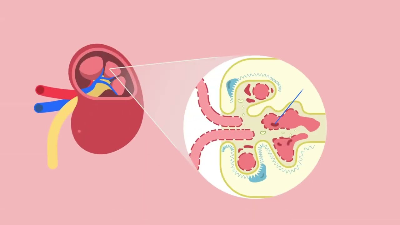 What is IgA Nephropathy? Thumbnail