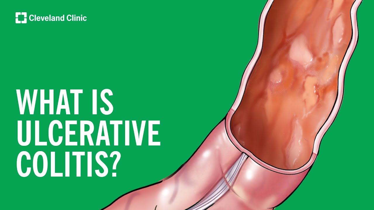 What Is Ulcerative Colitis? Thumbnail