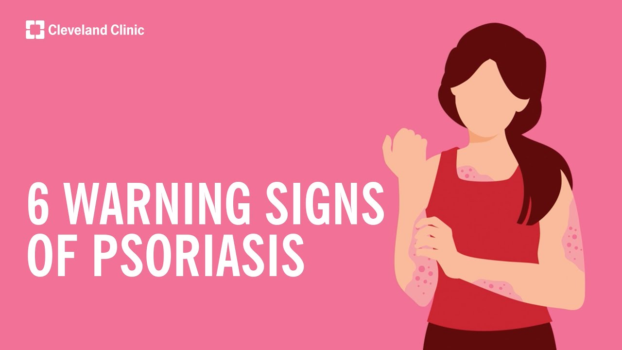 6 Warning Signs of Psoriasis Thumbnail