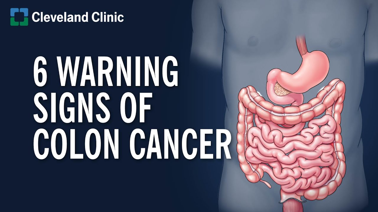 6 Warning Signs of Colon Cancer Thumbnail