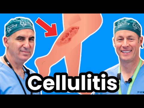 Cellulitis Explained By Infectious Disease Doctor Tom Warren, MD Thumbnail