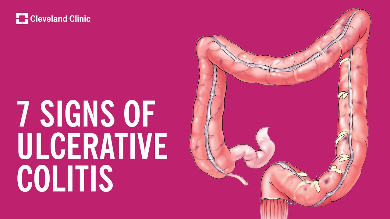 7 Warning Signs of Ulcerative Colitis Thumbnail