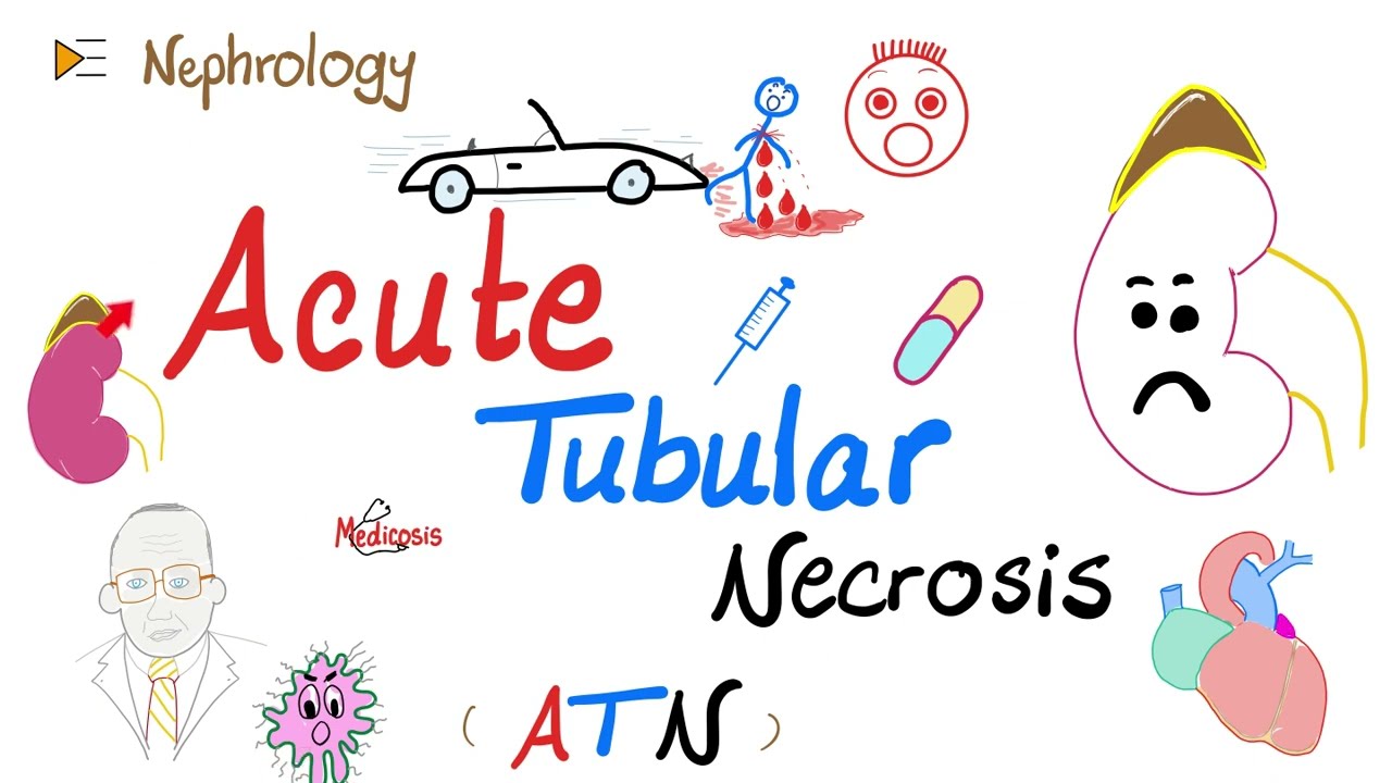 Acute Tubular Necrosis (ATN) – Azotemia – Acute Renal Failure (Acute Kidney Injury) – Nephrology Thumbnail