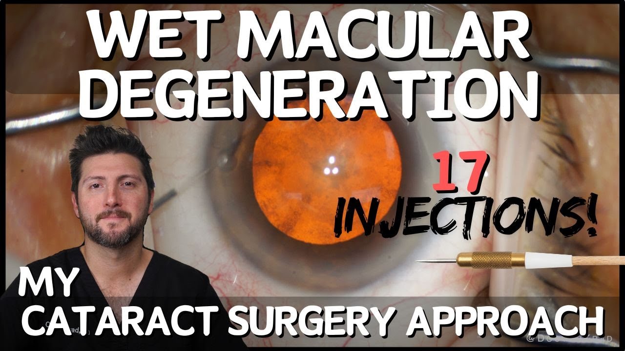 Cataract Surgery for Wet Macular Degeneration | Things to Consider Thumbnail
