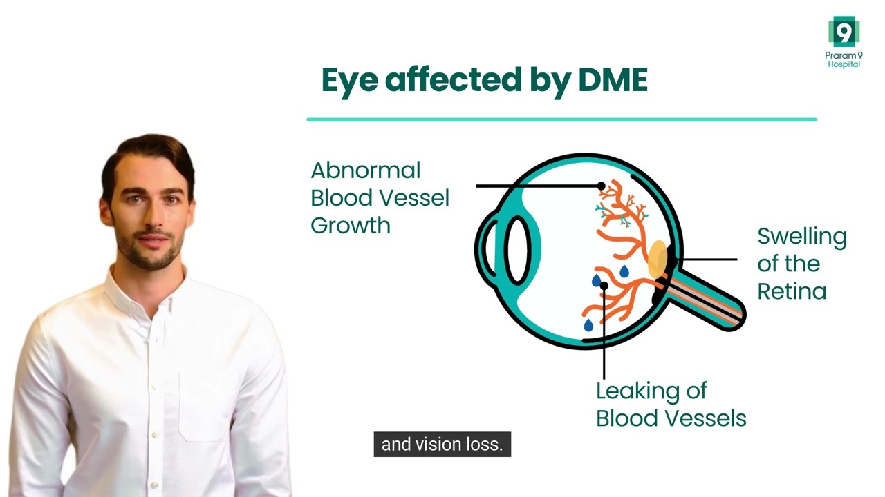 Diabetic Macular Edema (DME) Thumbnail