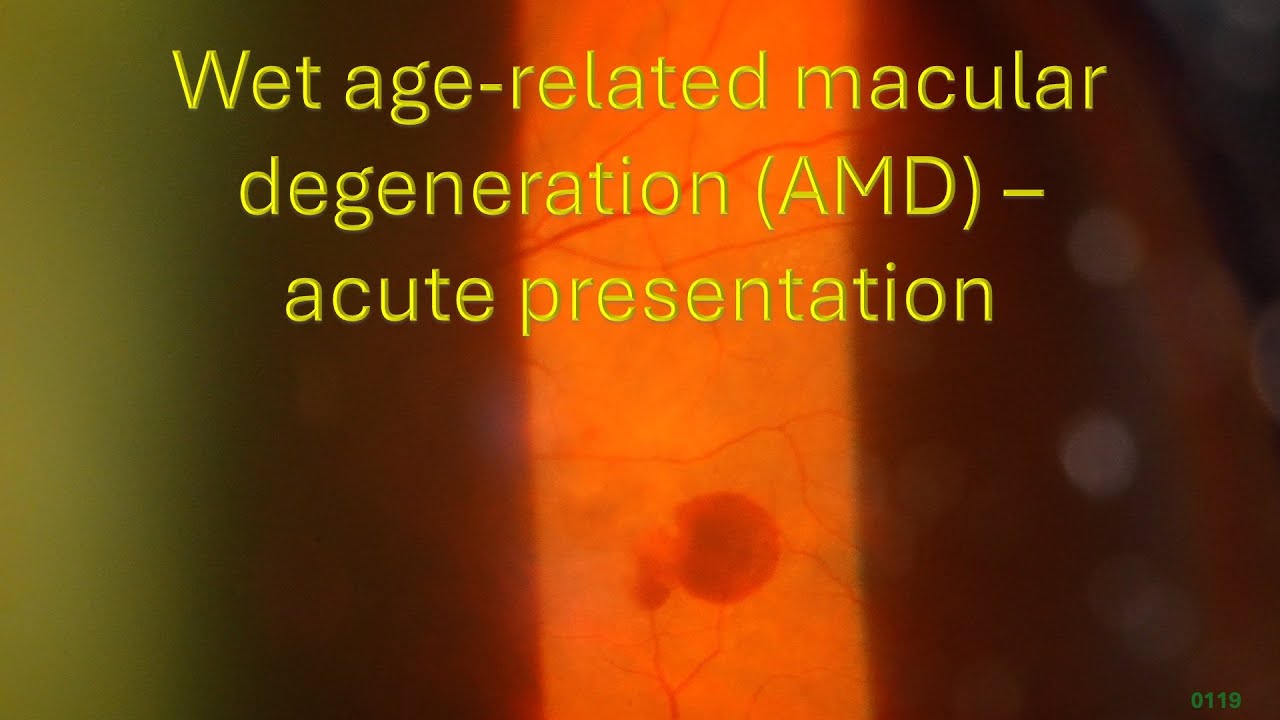 Wet Age-related Macular Degeneration (AMD) – Acute Presentation Thumbnail