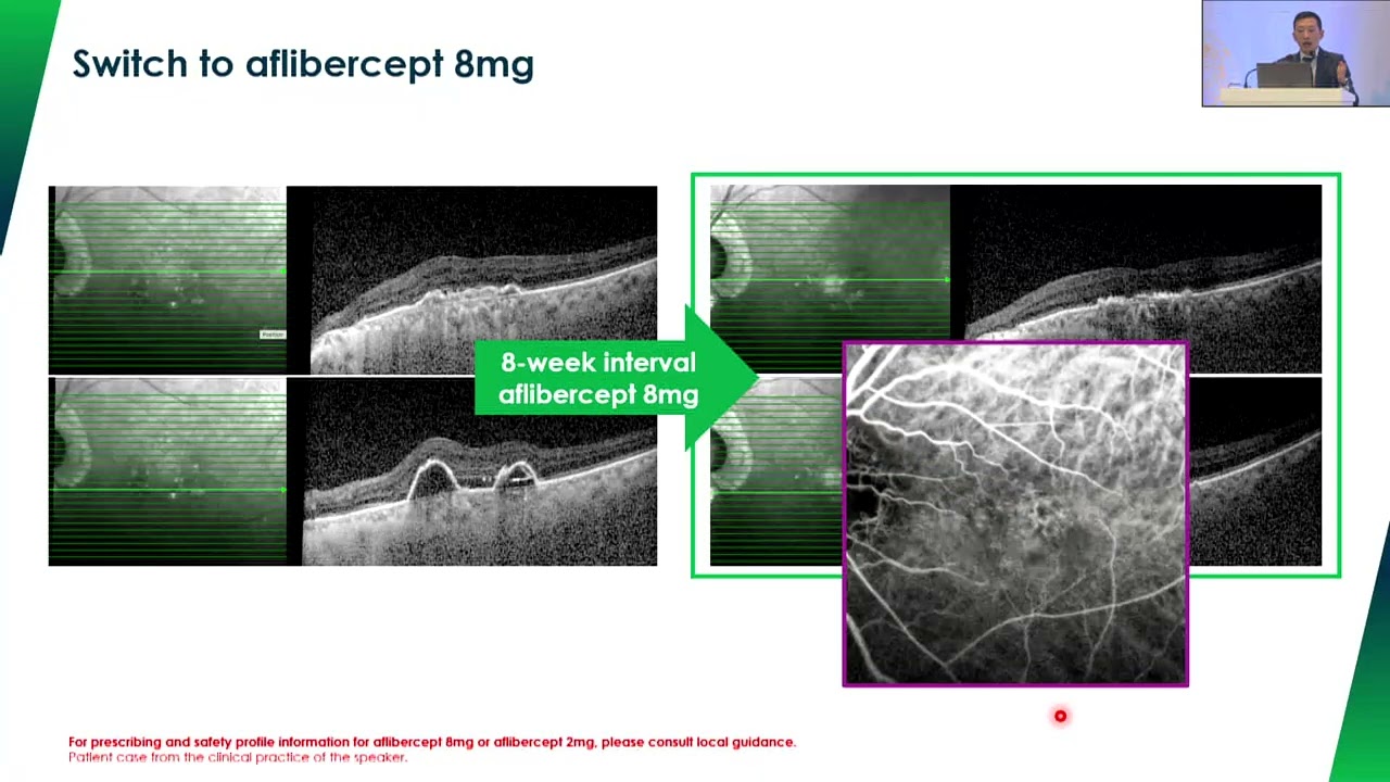 Early Fluid Resolution With High-Dose Aflibercept Thumbnail