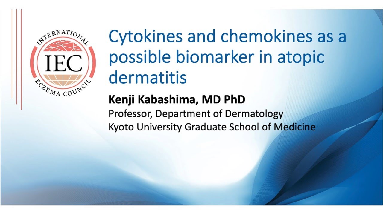Cytokines and chemokines as a possible biomarker in atopic dermatitis | Kenji Kabashima Thumbnail